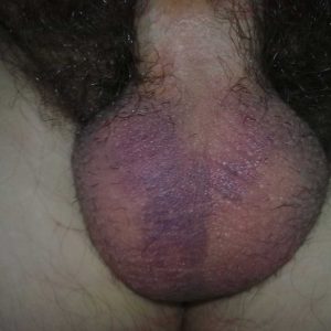 The bruising on scrotum starting to subside 11 days post-procedure