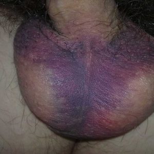 The scrotum with extensive bruising on day 5 post-procedure