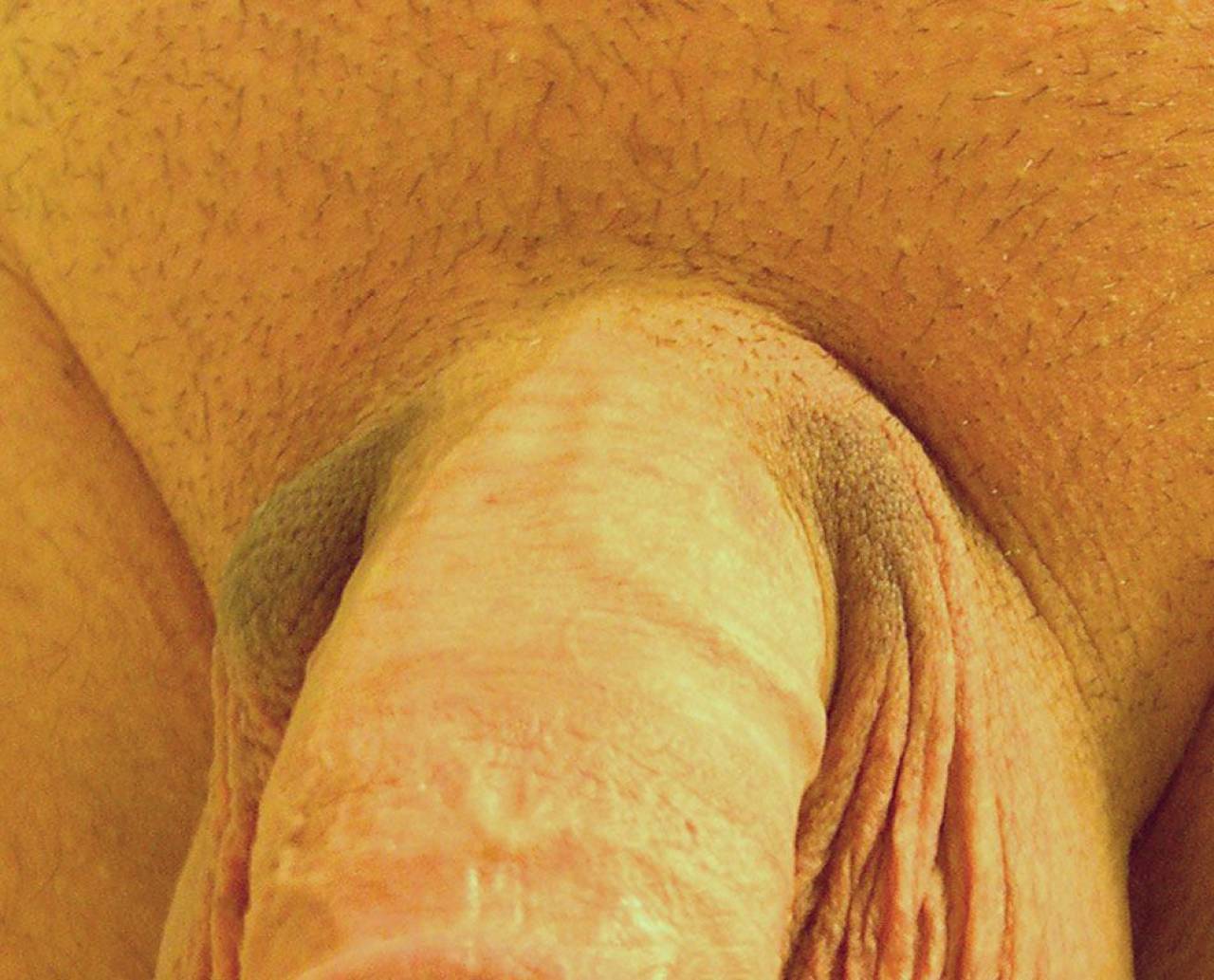 Bruising On Penis 43
