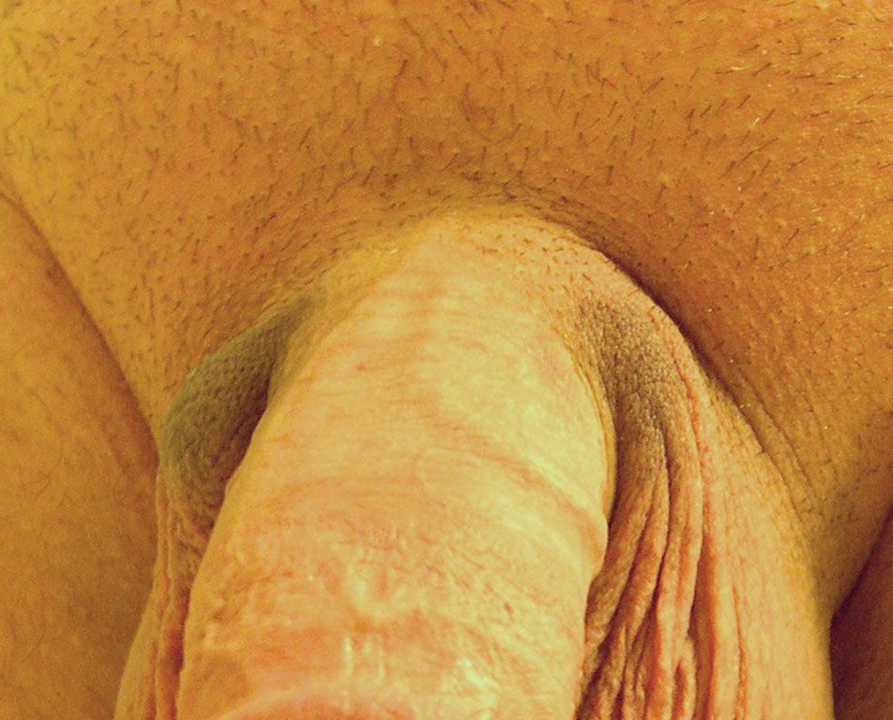 Penis Contusion 71