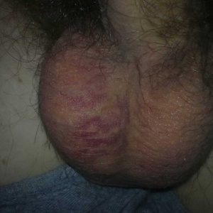 The bruising on scrotum rapidly subsiding 13 days post-procedure