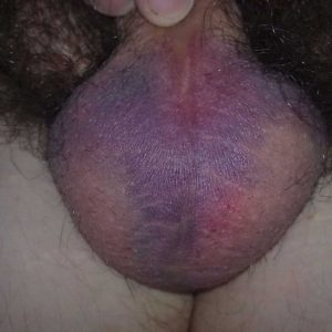 The scrotum with extensive bruising on day 7 post-procedure