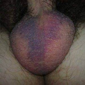The scrotum with extensive bruising on day 9 post-procedure