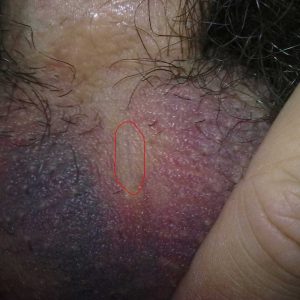 Close-up with marked incision