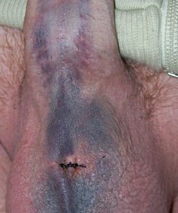 Extensive bruising up the penis 3 days after a vasectomy
