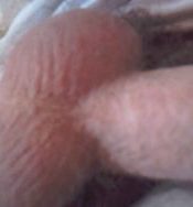 Close-up of vasectomy incision after six months