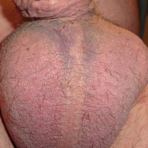 Post-vasectomy scotrum: Midline incision, noticeable swelling on the left and bruising