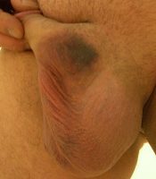 Bruising on the left side 5 days after a vasectomy