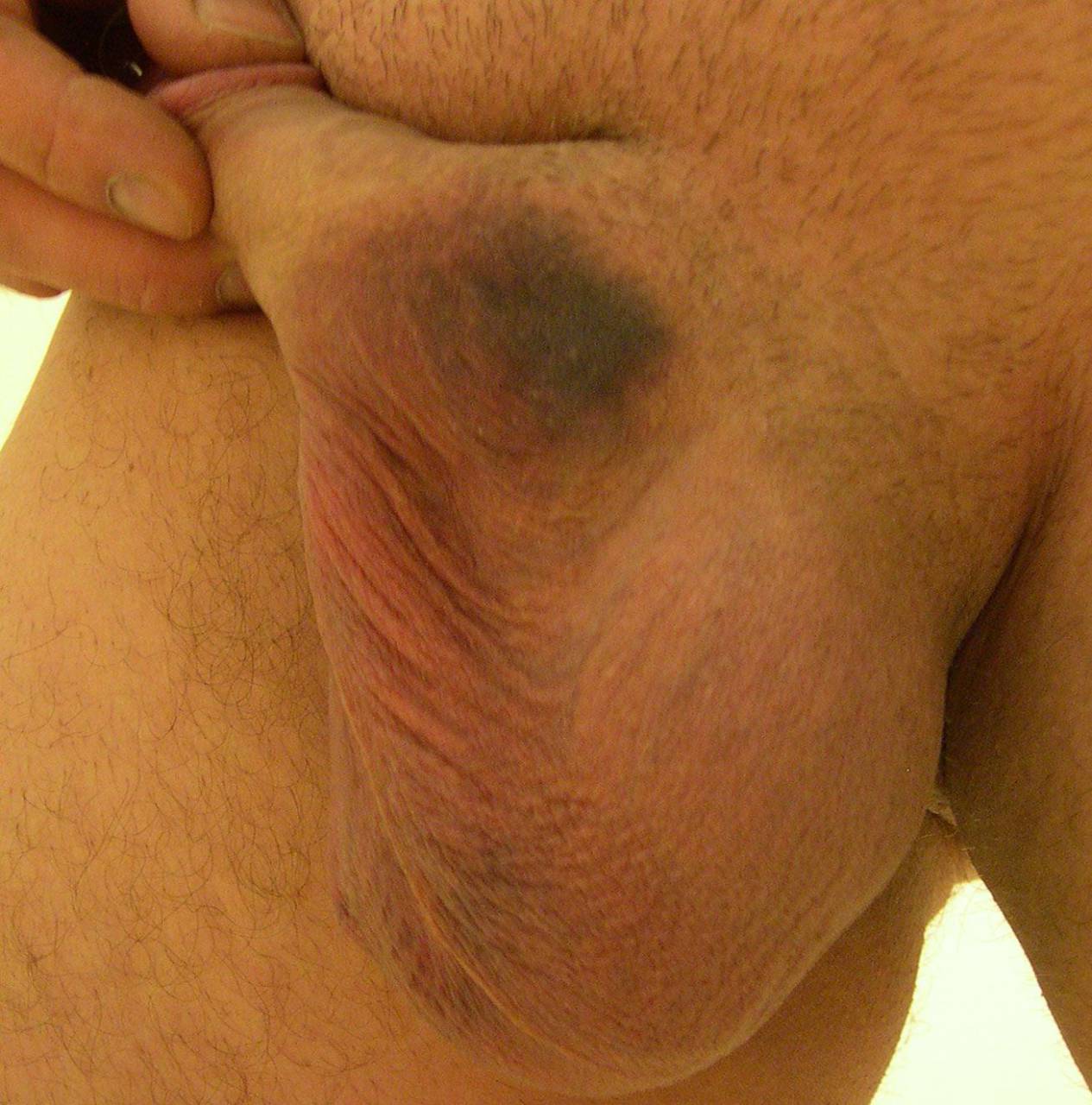 Swelling and bruising 5 days after a vasectomy.