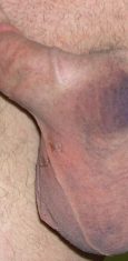 Bruising on the left side. Alternative angle.