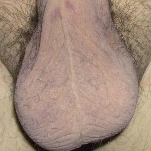 Full view of the scrotum one month post-op