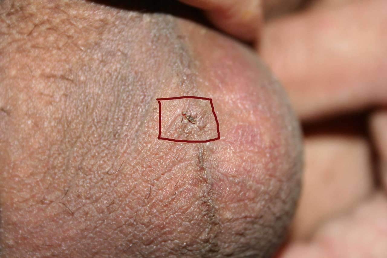 Vasectomy incision close-up on the left testicle (day 6) .