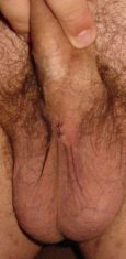 Post-vasectomy scrotum on day 4
