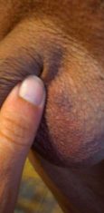 2 days after vasectomy, left side close up