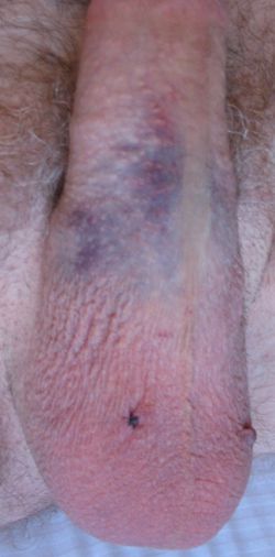 Swelling and bruising: How long will it last?