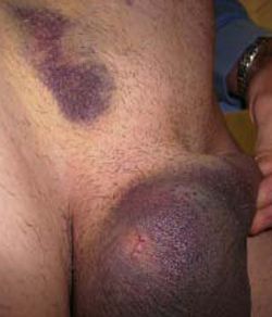 Vasectomy incision above the right testicle, plus all the bruising and swelling