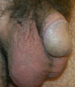 Location of the right incision