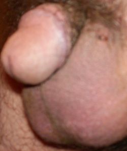 The site of the left incision.