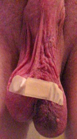 Vasectomy wound with a plaster on day 1