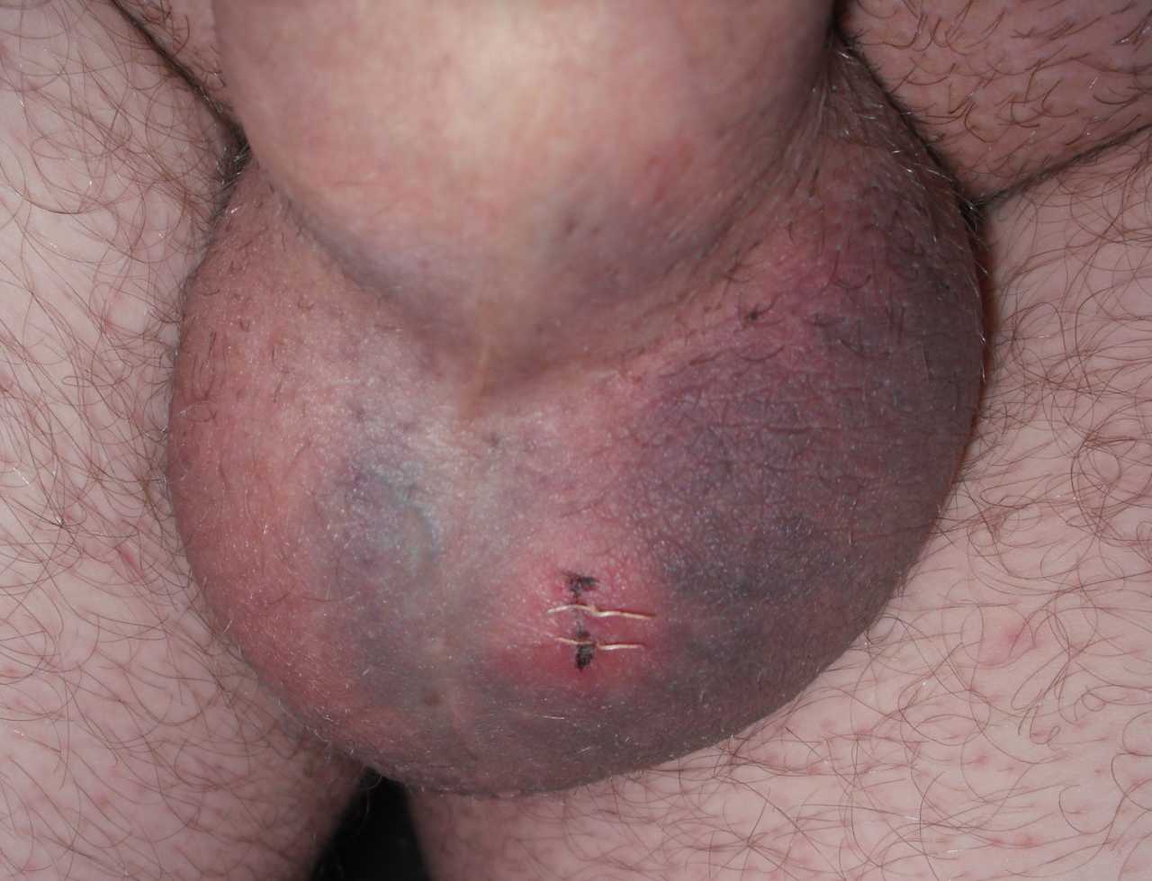 Typical bruising after no-scalpel vasectomy on day 5. 