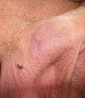 Vasectomy incision on the right side (Day 3)