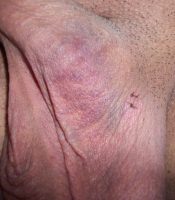 Vasectomy incision on the left side (Day 3)
