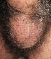 Scrotum with one testicle 16 hours after a vasectomy