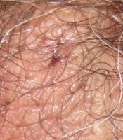 Close-up of vasectomy incision 16 hours after the surgery