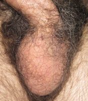 Scrotum with one testicle 48 hours after a vasectomy