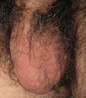 Scrotum with one testicle 5 days after a vasectomy