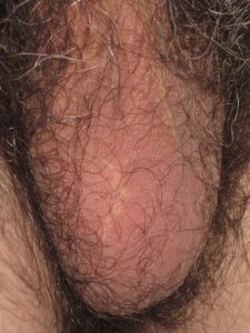 Scrotum with one testicle 8 days after a vasectomy