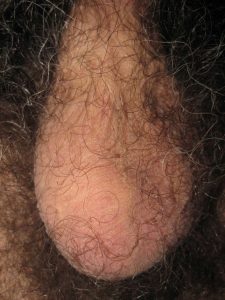 Scrotum with one testicle 3 weeks after a vasectomy