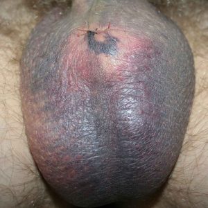 Hematoma with discolored scotrum a week after a vasectomy