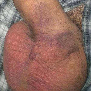 Vasectomy site 4 days after the procedure