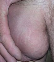 Vasectomy scar left side