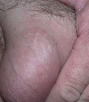 Vasectomy scar right side