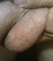 Bilateral vasectomy scarring left side