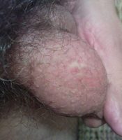 Bilateral vasectomy scarring right side
